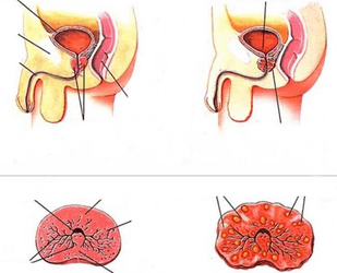 normalni prostati in kronični prostatitis