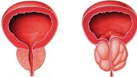 normalna in vneta prostata