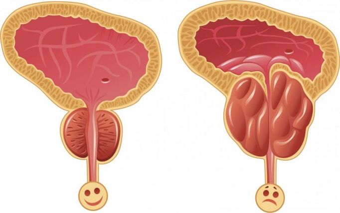 zdrava in vneta prostata s prostatitisom