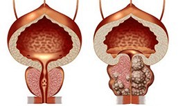 Zdravo in nezdravo prostate