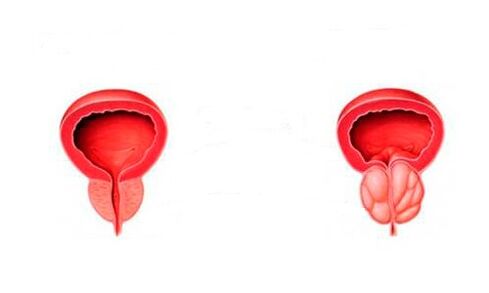 zdrava in vneta prostata s prostatitisom