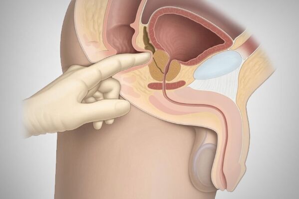 Masaža prostate pri bakterijskem prostatitisu